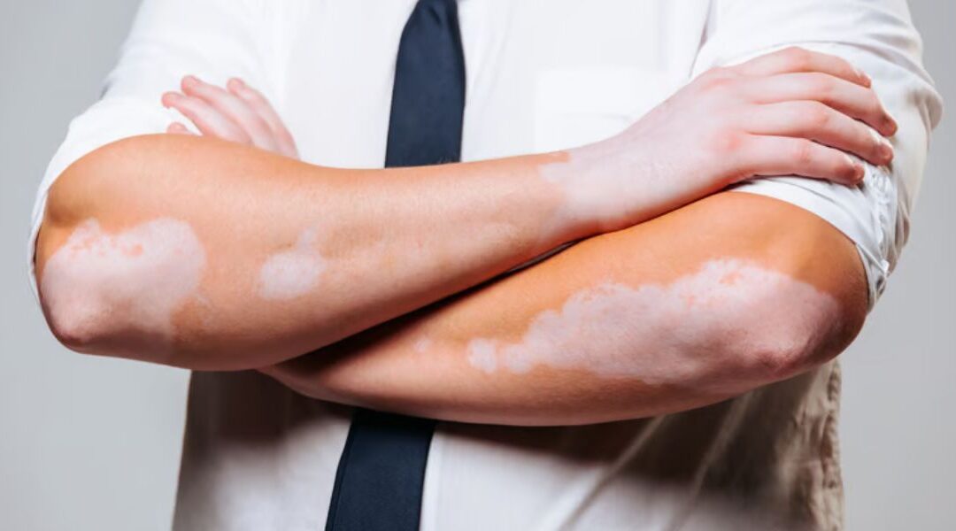 Vitiligo in 2026: Combination Immunotherapy and Light-Based Protocols