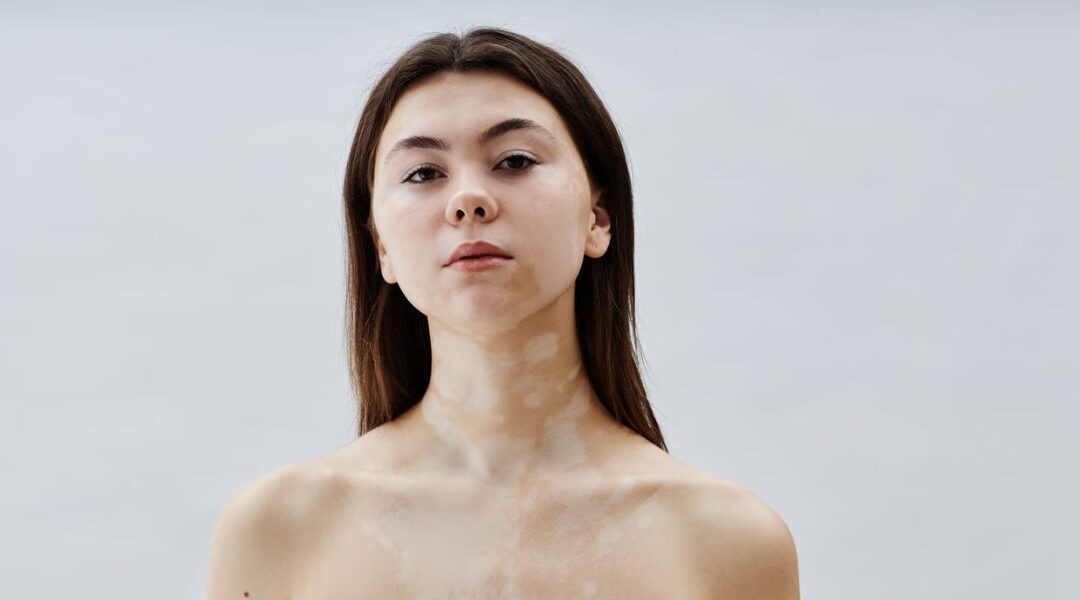 Vitiligo on the Face: Why It Behaves Differently
