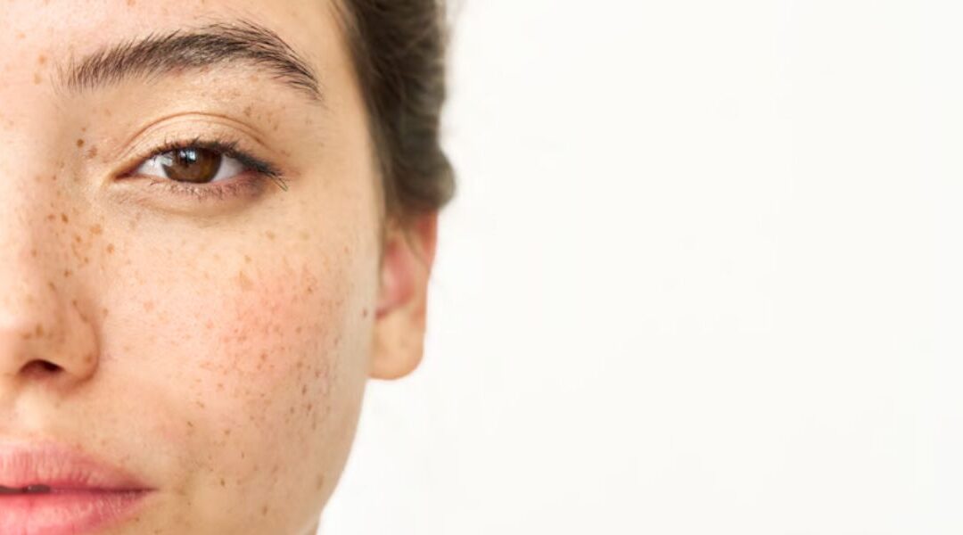 Can Melasma Be Prevented? What You Need to Know