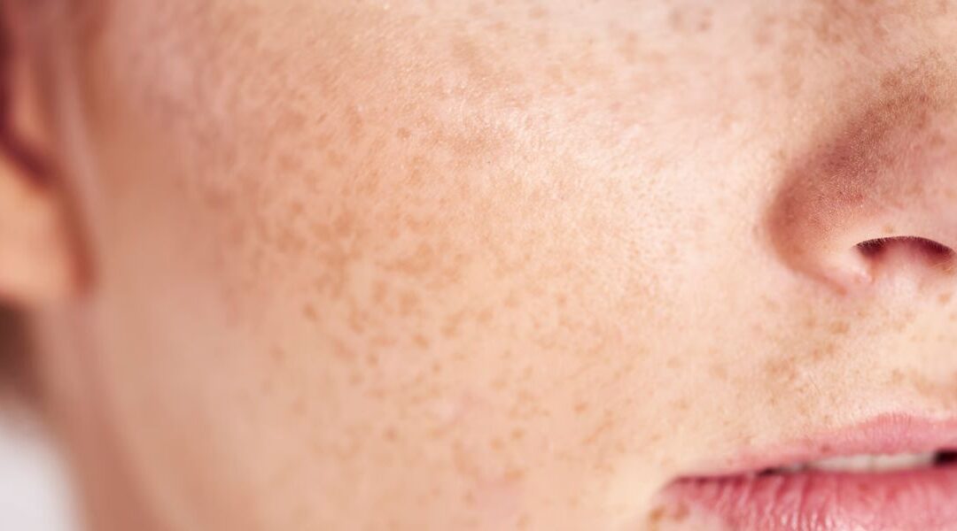 Melasma After Pregnancy: How Long Does It Last and When to Treat It