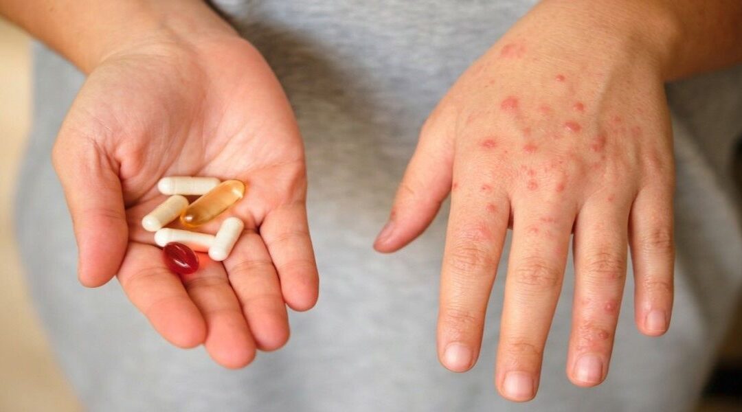 Cutaneous Drug Reactions: Why the Skin Is Often the First Organ to React