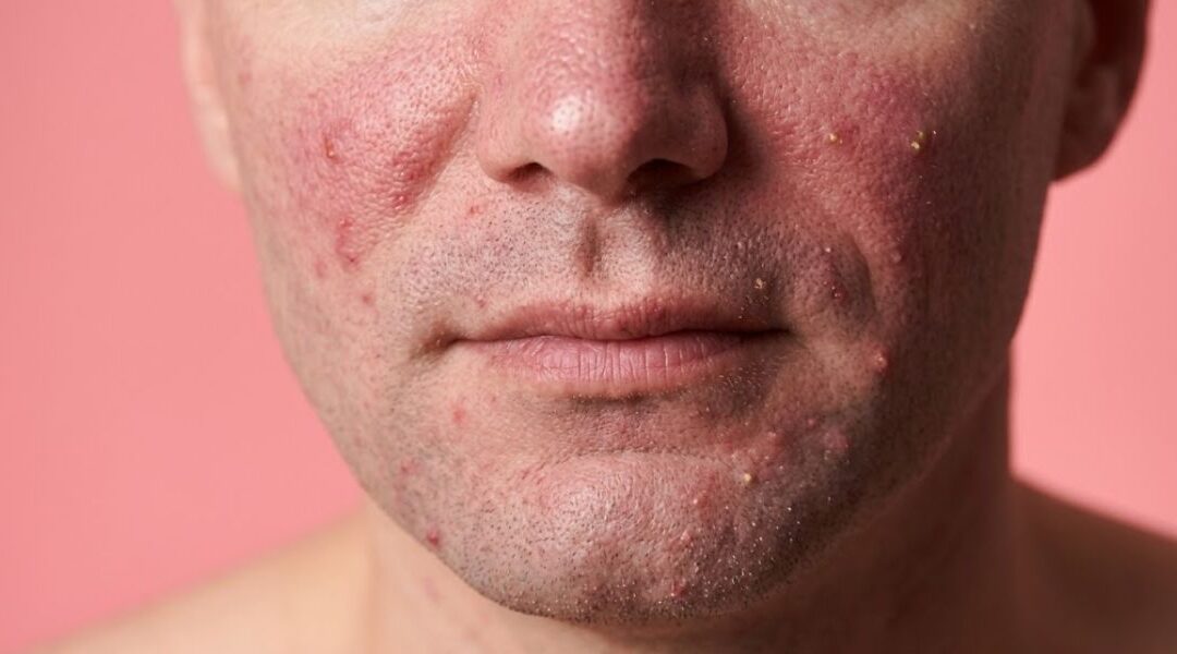 Rosacea in Men: How It Can Present Differently
