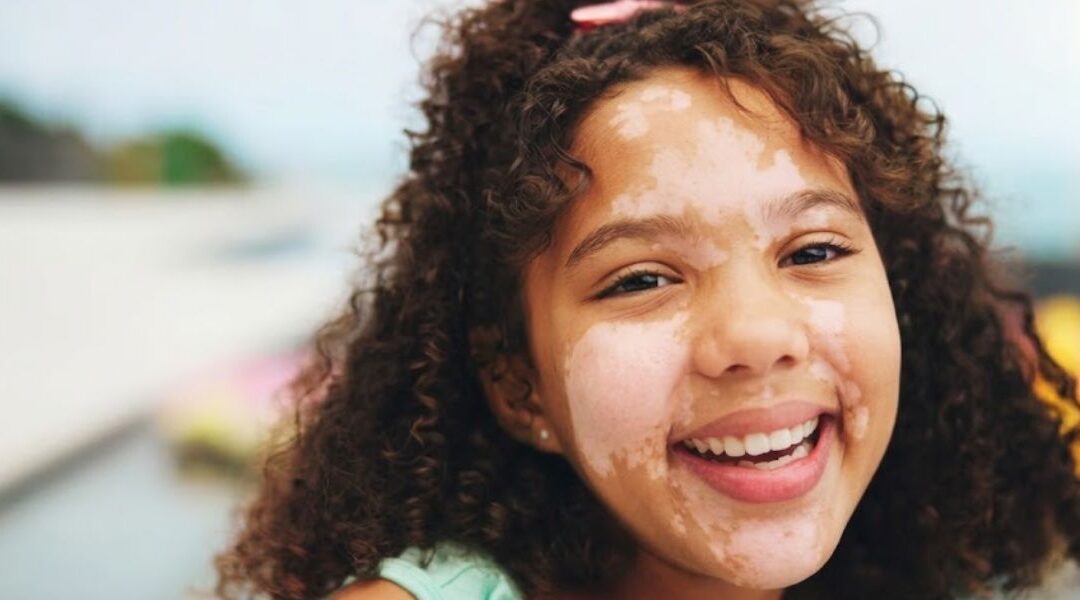 Vitiligo in Children: How It Differs From Adult Cases
