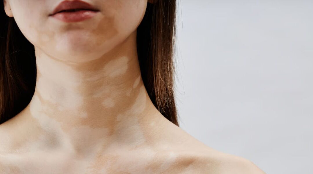 Resident Memory T Cells in Vitiligo: Why Depigmentation Returns