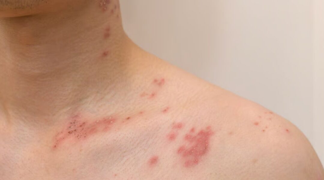 Distribution Patterns in Dermatology: Why Where a Rash Appears Matters