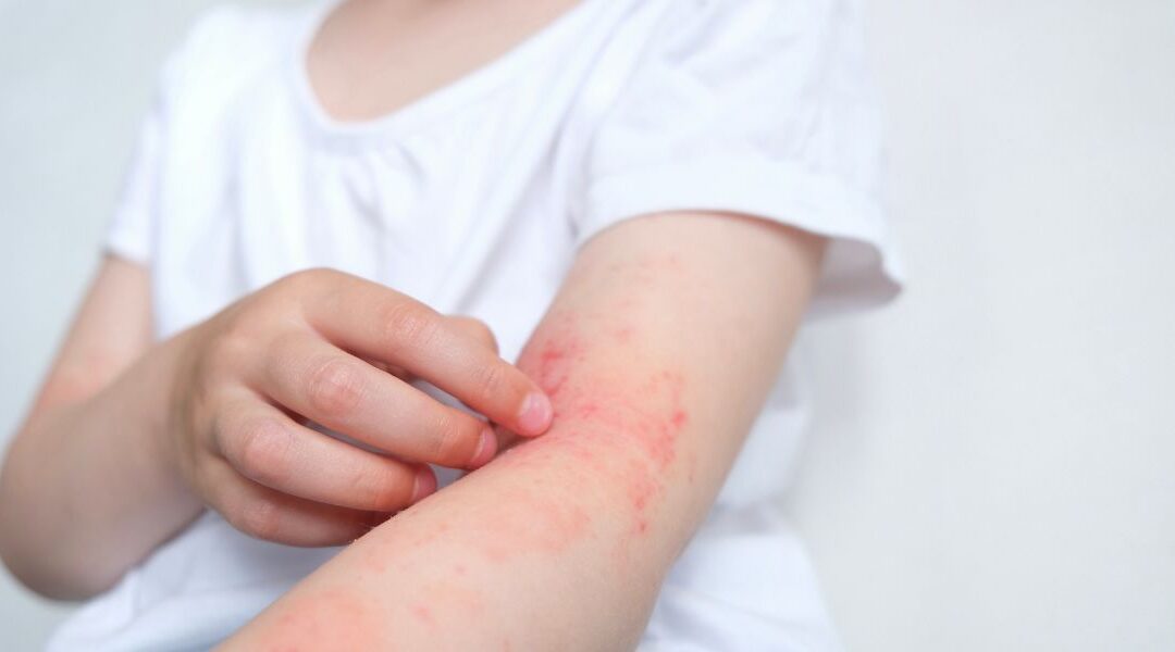 Autoimmune Skin Diseases That Affect Women More Often