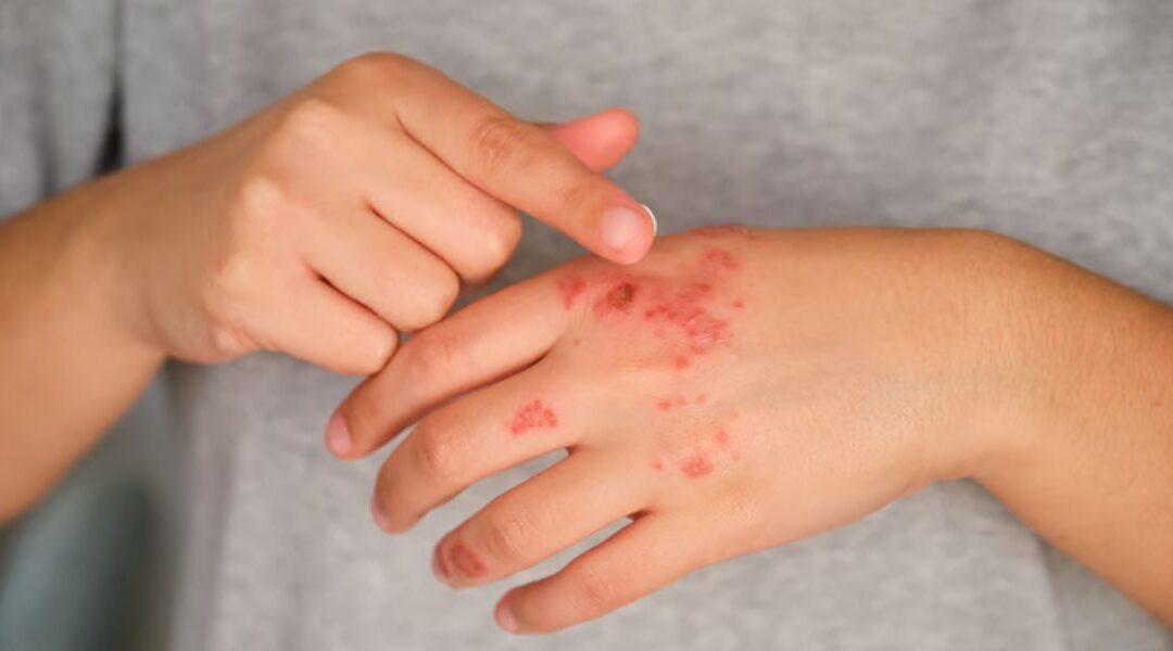 Targeting IL-31 in Eczema: New Treatments for Chronic Itch