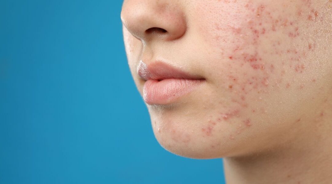 Persistent Facial Redness: When It Is Rosacea and When It Is Not