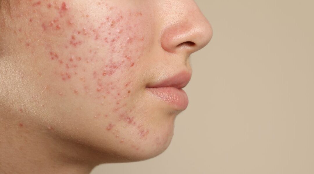 Rosacea Burning and Stinging: Why Some Patients Feel Skin Sensitivity