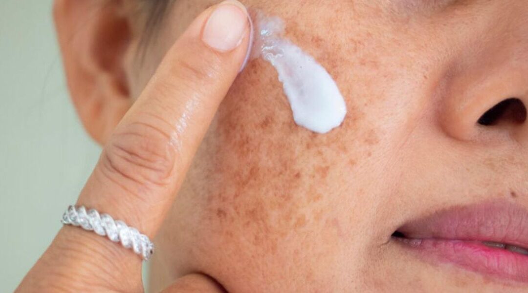 Hydroquinone for Melasma: Benefits, Risks and What to Expect