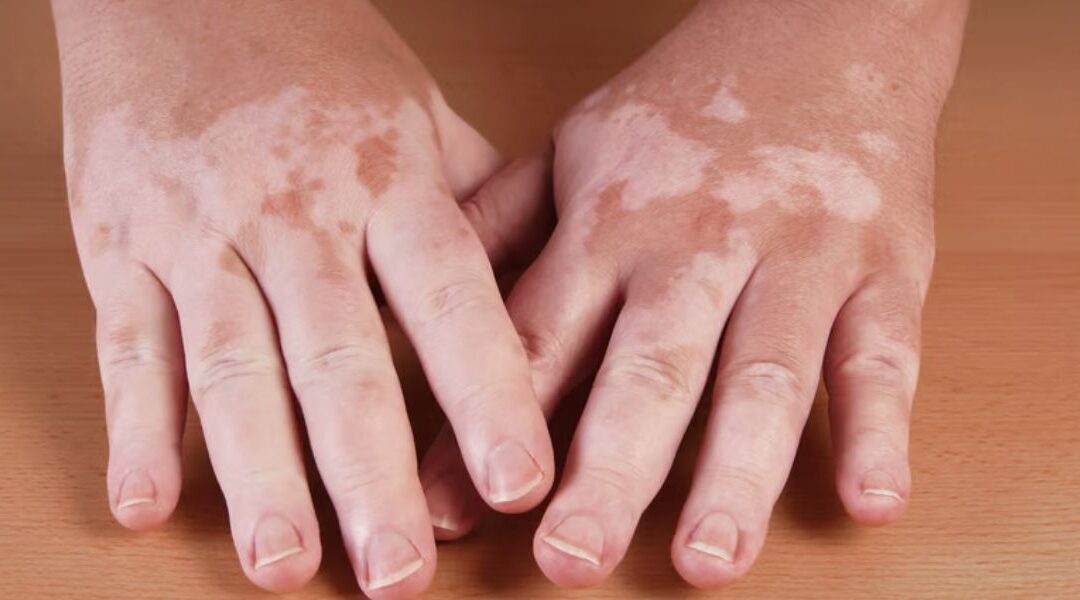 Early Signs of Vitiligo: What to Look For