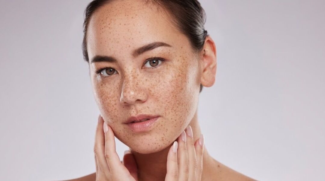 How to Get Rid of Liver Spots Naturally