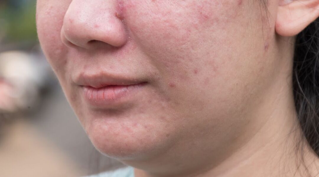 Can Alcohol Cause Broken Capillaries on the Face?