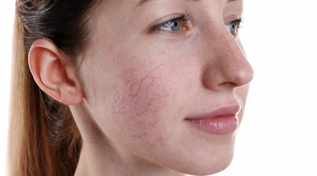 Do Broken Capillaries Get Worse Over Time?