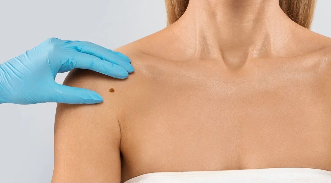 Skin Tags: What Causes Them and Should They Be Removed?