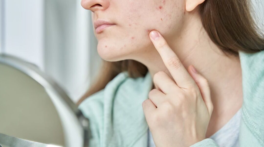 Acne and Endometriosis: Is There a Hormonal Link?