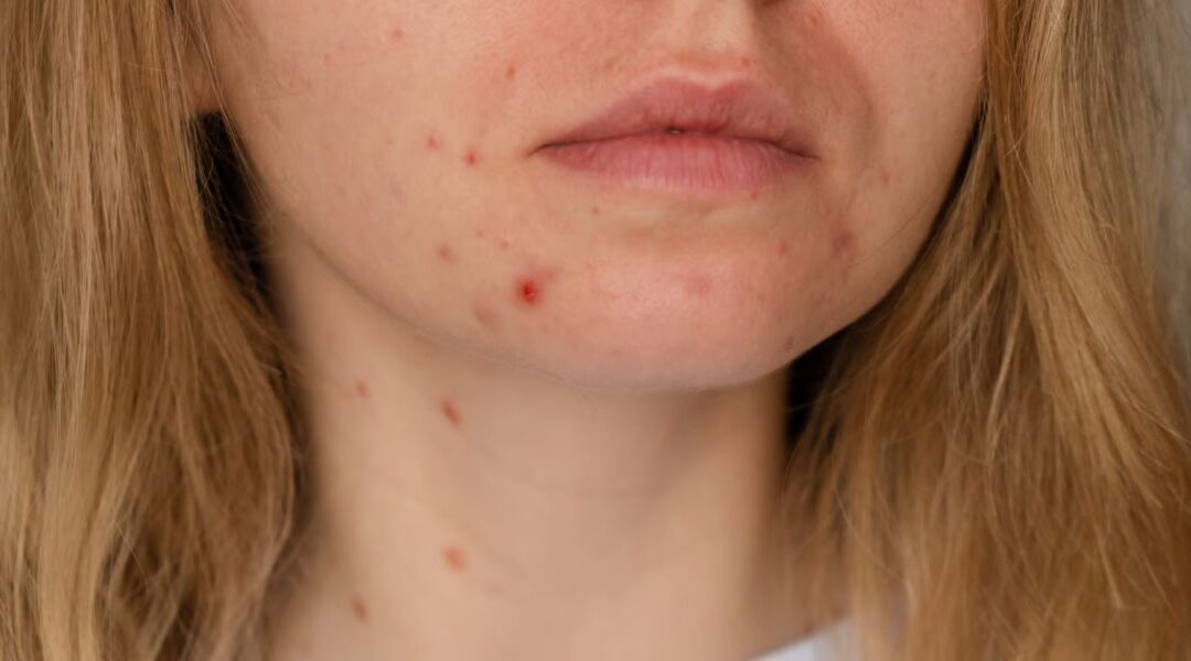 Acne Caused by Hormonal Contraception: What to Expect