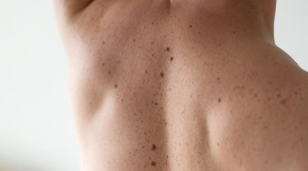 Do Liver Spots Ever Go Away?