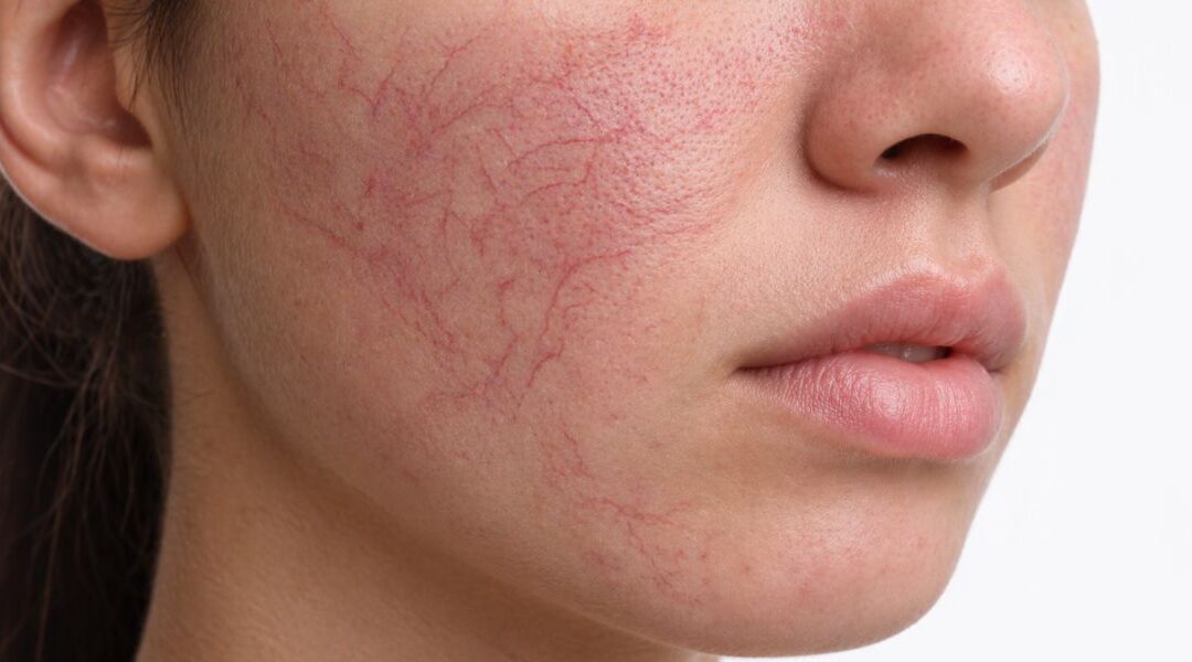 Why Do Broken Capillaries Keep Coming Back After Treatment?