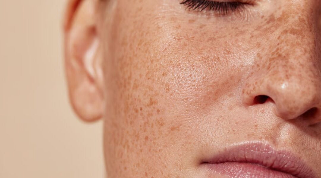 Does Blue Light Make Melasma Worse? What Patients Should Know