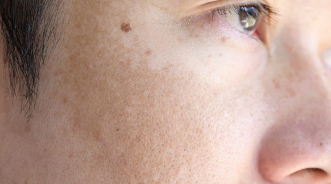 What Do Liver Spots Indicate?