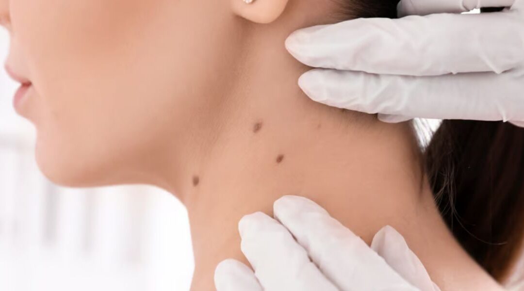 Can Basal Cell Carcinoma Develop in Areas Not Exposed to the Sun?