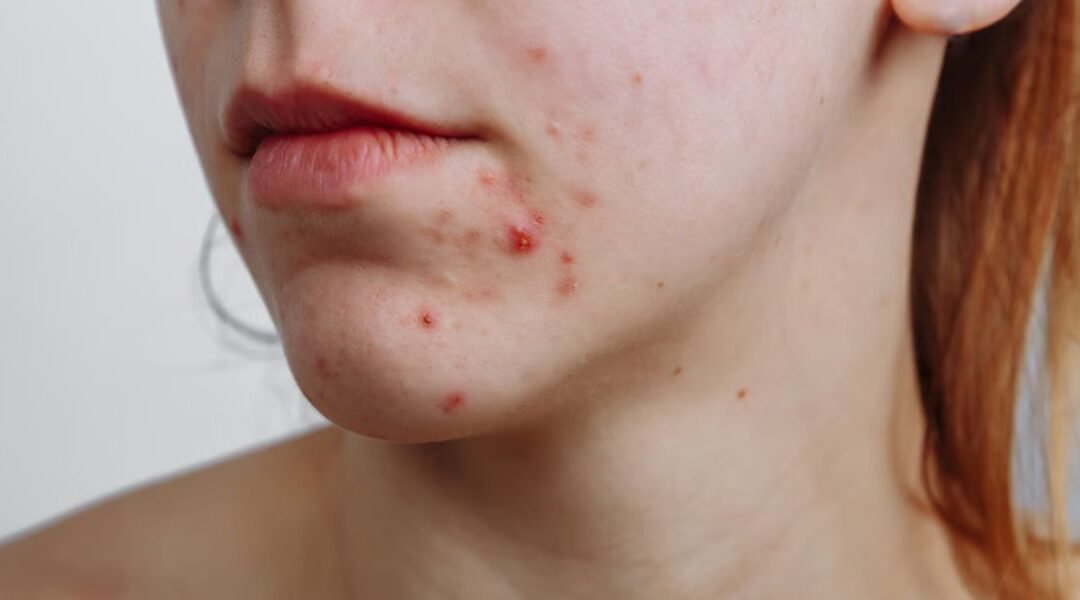 Acne and High Testosterone Levels: What You Should Know
