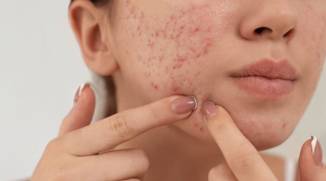 Acne and Insulin Resistance: Is There a Connection?