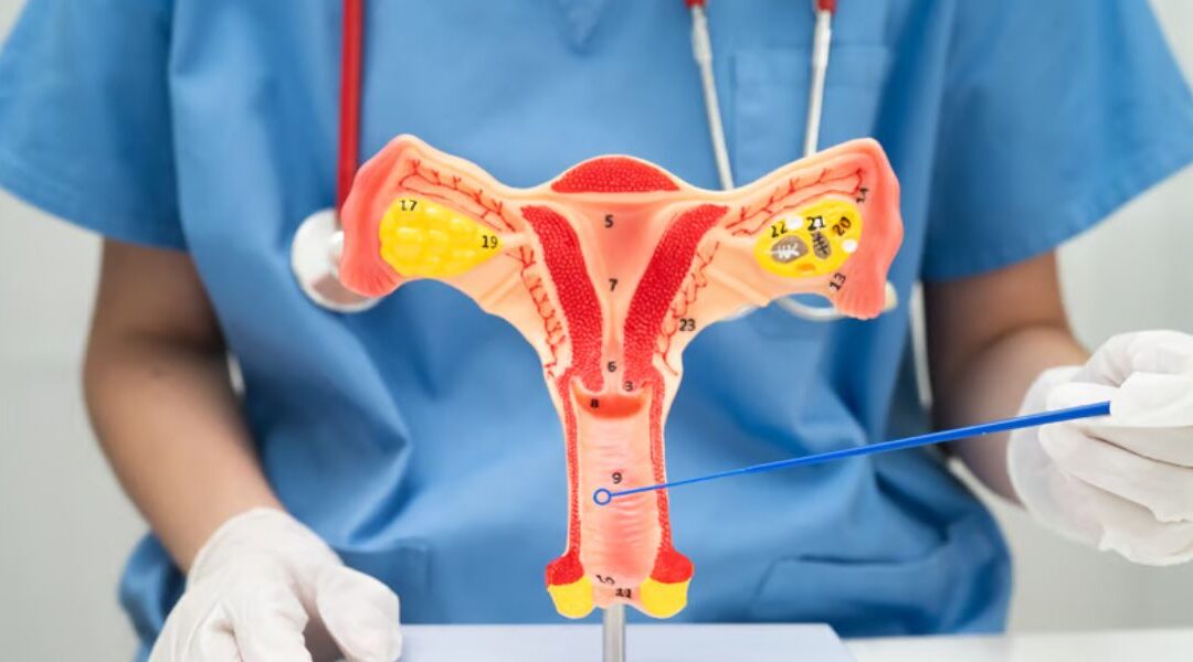 Acne and Polycystic Ovary Syndrome (PCOS): What’s the Link?