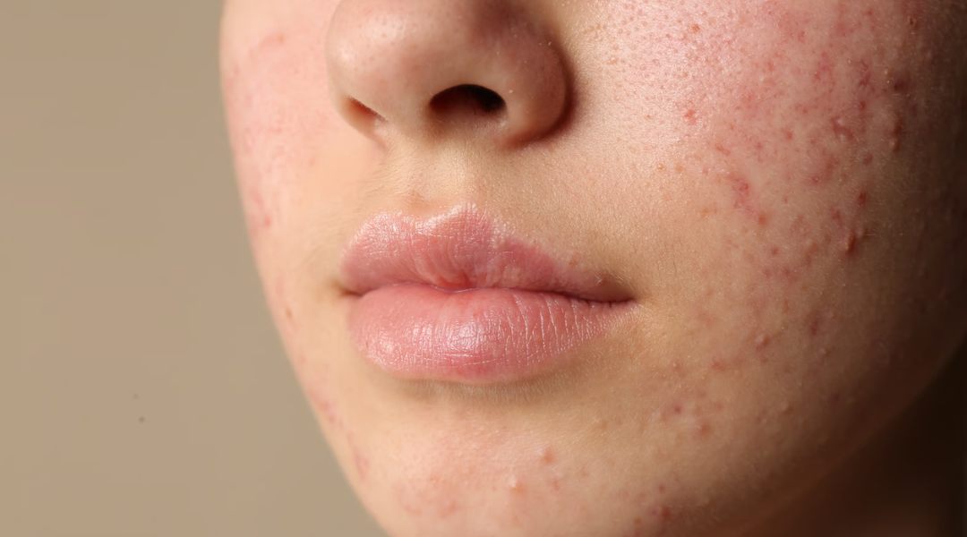 Acne and Anabolic Steroids: Understanding the Risks