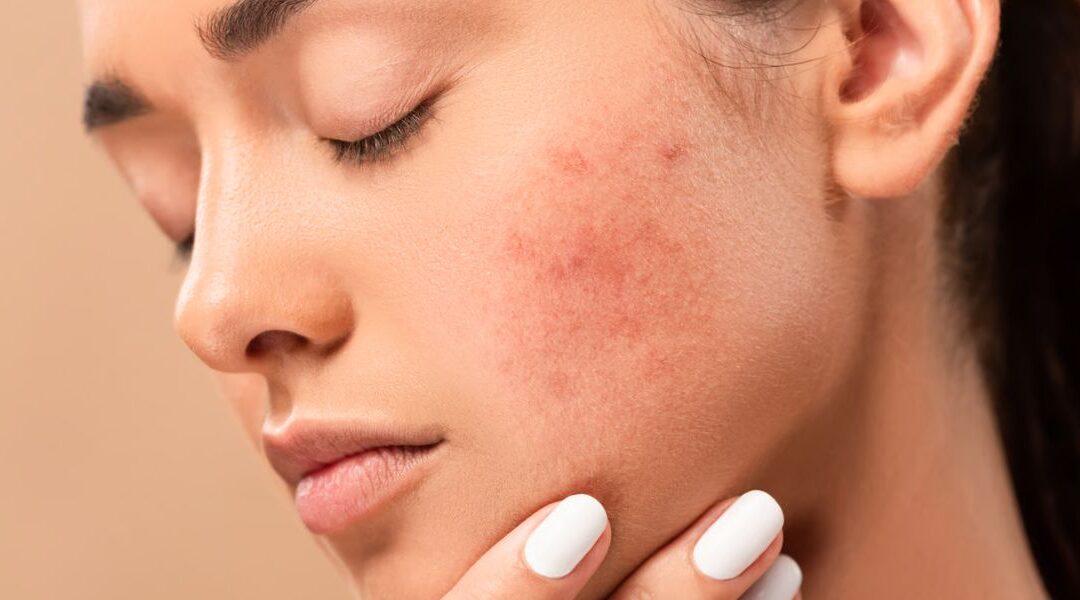 Acne and Gut Health: What Does the Evidence Say?