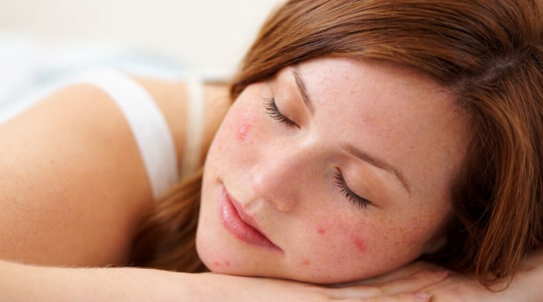 Acne and Sleep Deprivation: Does Poor Sleep Affect Your Skin?
