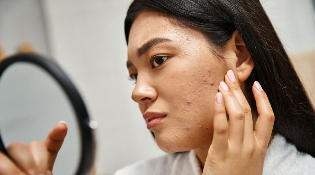 Acne and Stress Hormones: Understanding the Cortisol Connection