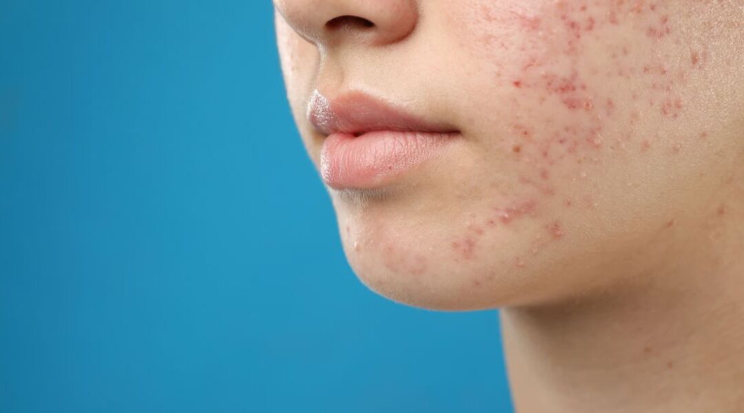 Acne and Thyroid Disorders: Can There Be a Link?