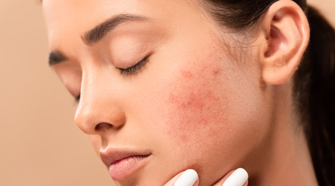 Broken Capillaries on the Face: Causes and Treatment Options