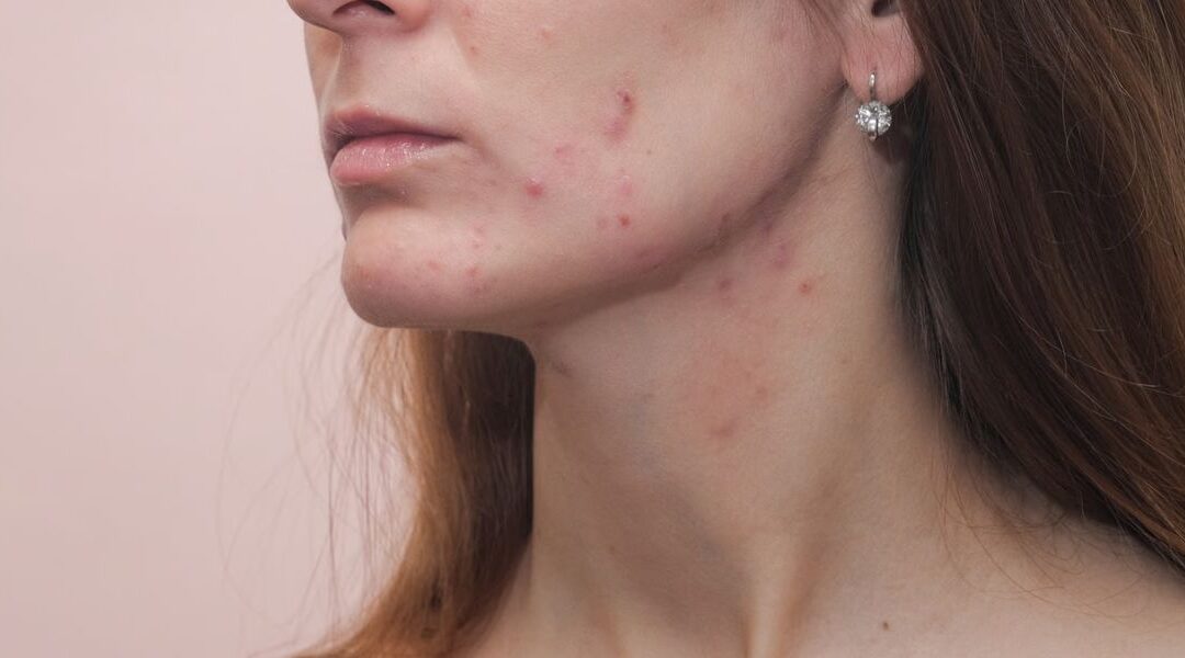 Can Lithium and Other Psychiatric Medications Cause Acne?