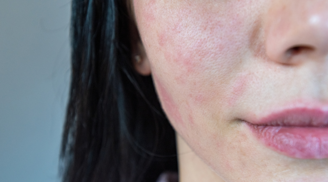Can Broken Capillaries Be Prevented?