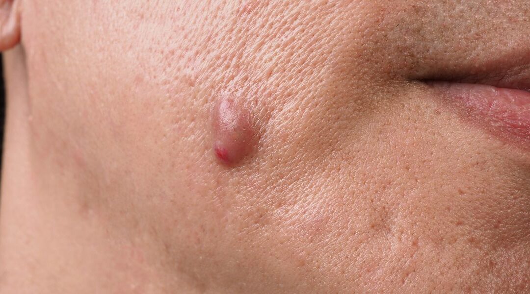 Can Basal Cell Carcinoma Occur in Younger Patients?