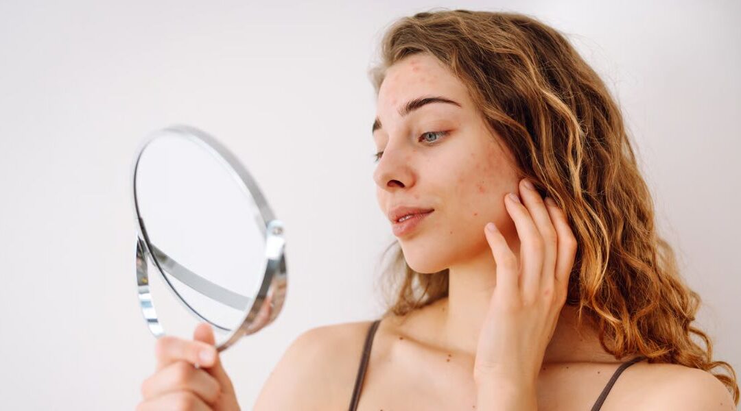 Can Certain Medications Trigger Acne Breakouts?