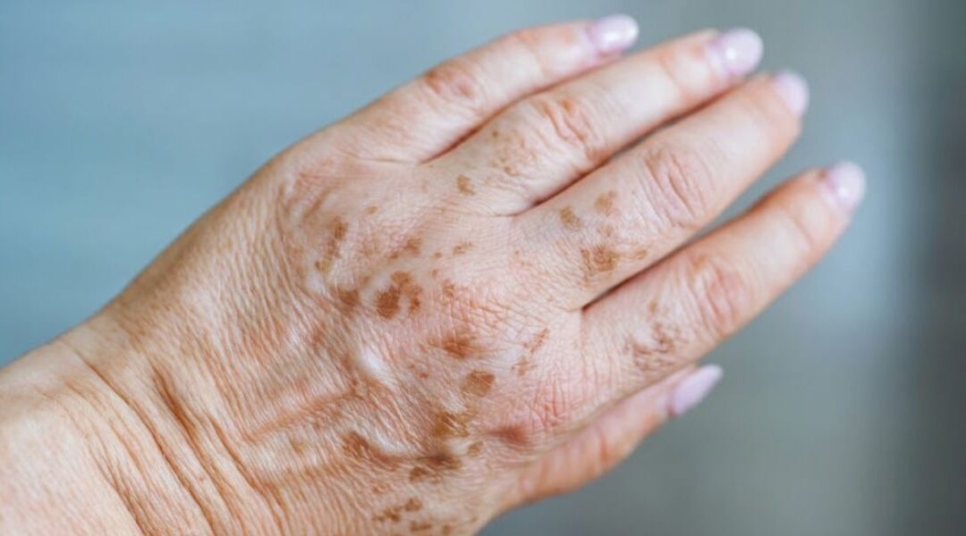 What Can Be Mistaken for Liver Spots?