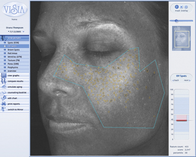 Visia Screen UV Spots