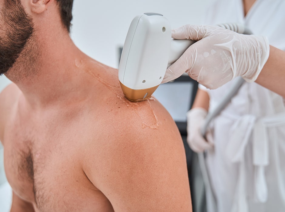 Expert Laser Birthmark Removal in London