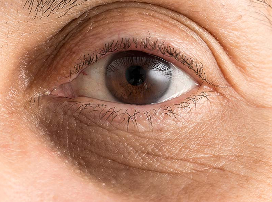 Dark Circles Treatment London