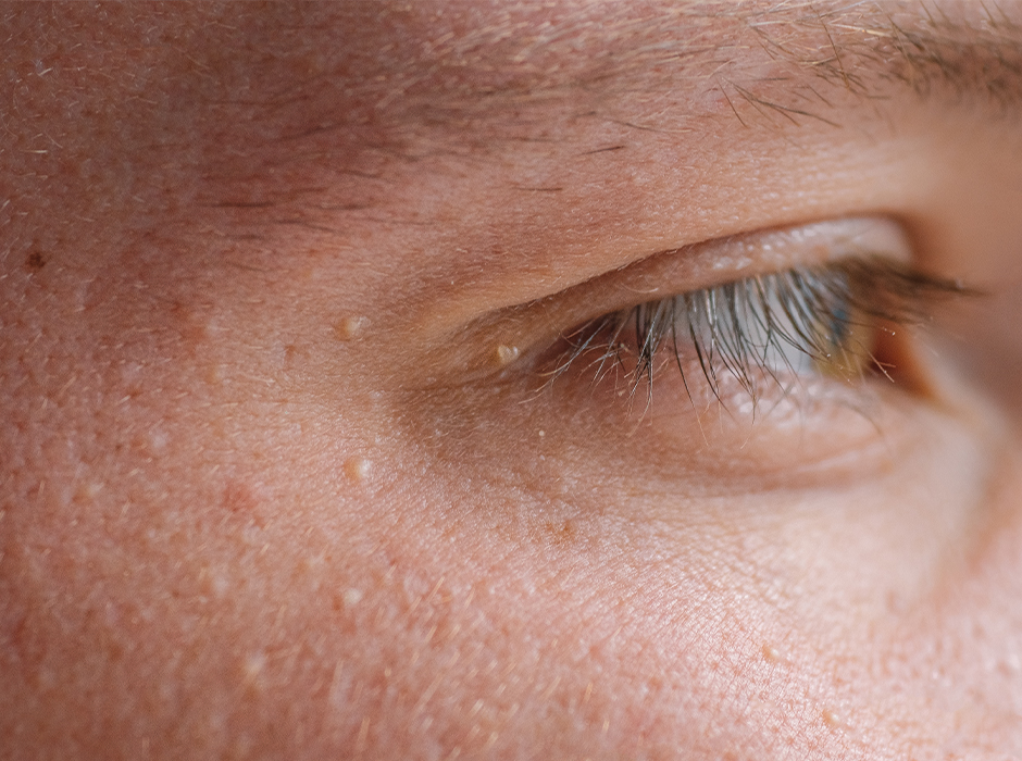 Milia Treatment in London