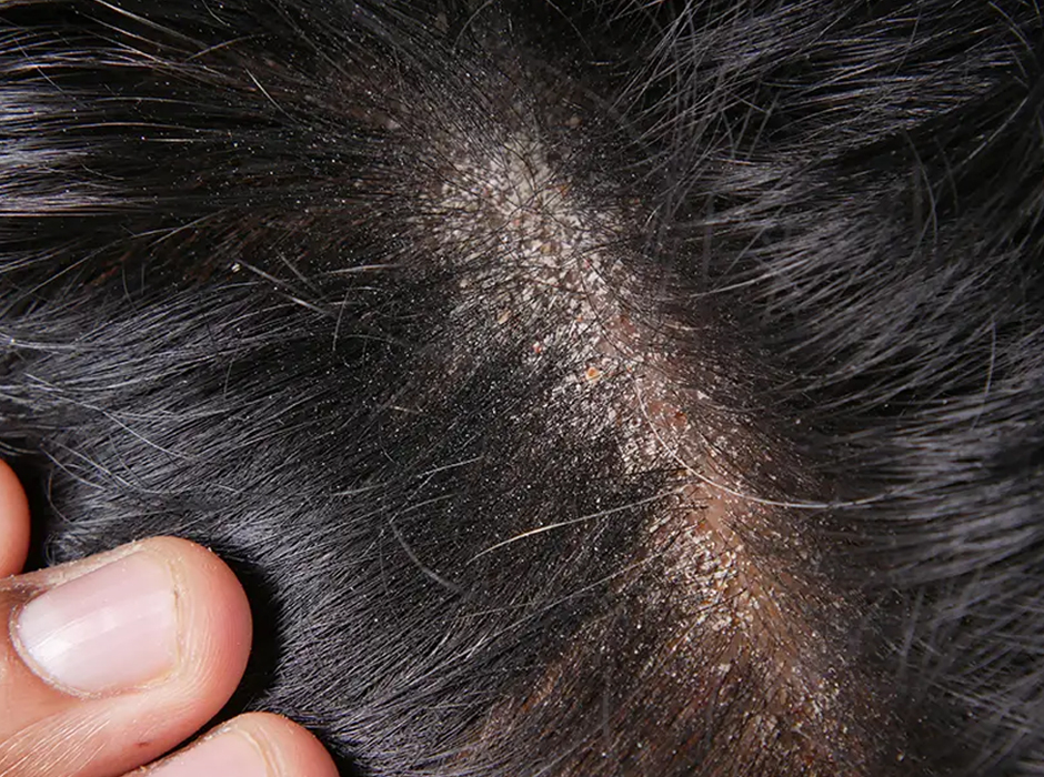 Scalp Dermatologist London