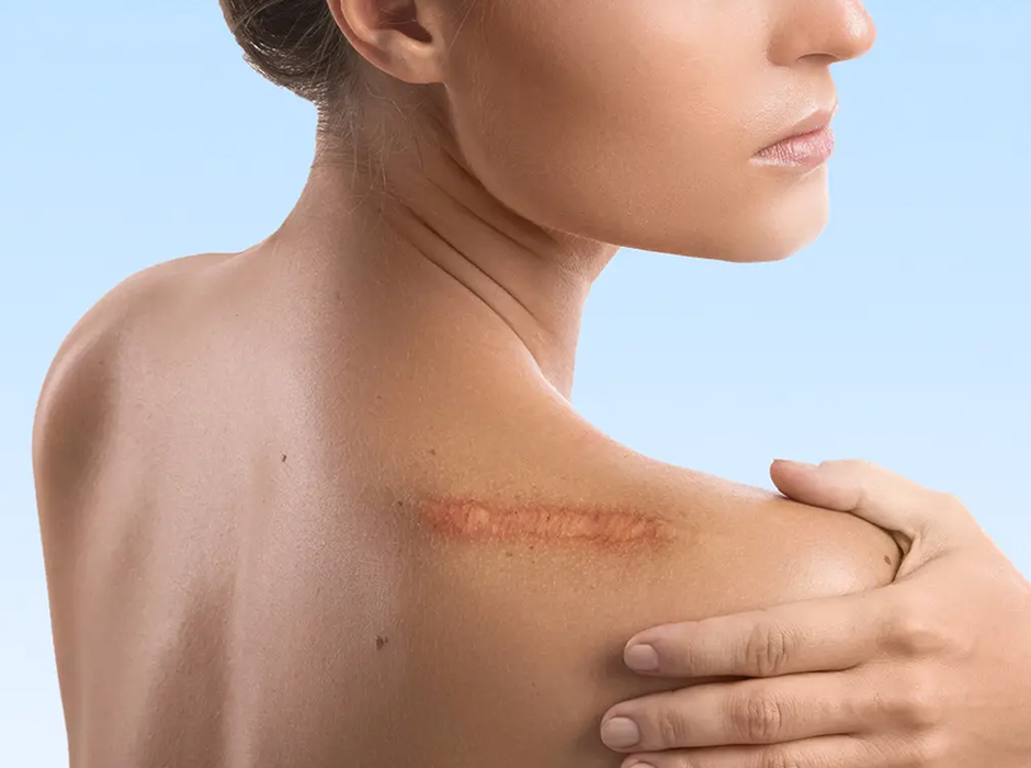 Scar Treatment London