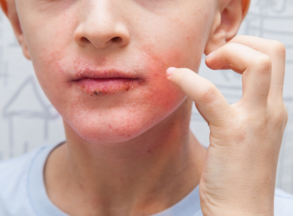 Private Seborrhoeic Dermatitis Treatment 