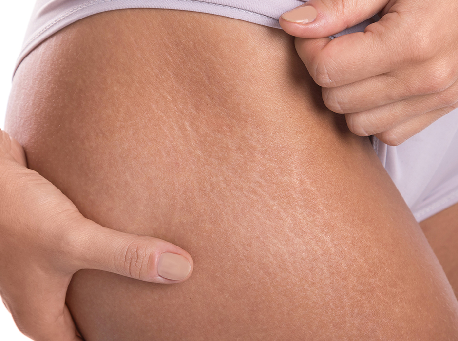 Stretch Marks Treatment London