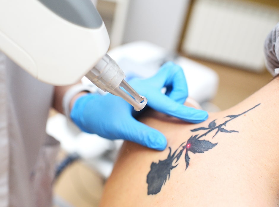 Tattoo Removal London