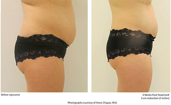 Before and After Liposonix